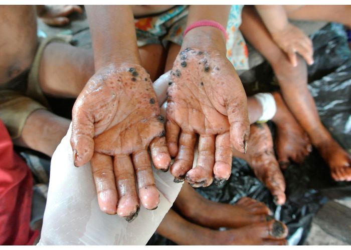 Fortaleza Labour Department TropicalMed | Free Full-Text | The Effectiveness of Topical ... photo